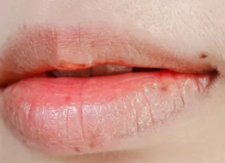 Manchas nos lábios podem ser indicativo de doenças, alerta especialista