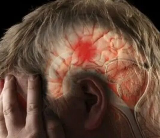 Maranhão registra 1.258 casos de AVC no primeiro semestre de 2025